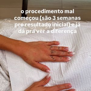 Gkay mostrou o resultado do procedimento, cujos efeitos definitivos devem aparecer em cerca de 3 semanas