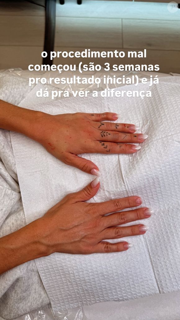 Gkay mostrou o resultado do procedimento, cujos efeitos definitivos devem aparecer em cerca de 3 semanas