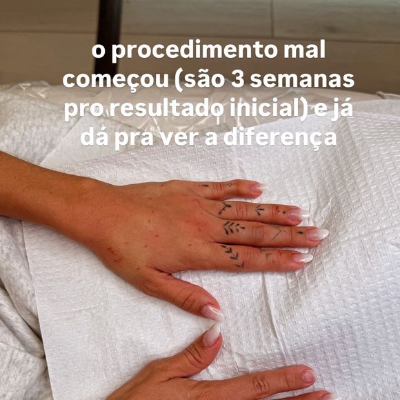 Gkay mostrou o resultado do procedimento, cujos efeitos definitivos devem aparecer em cerca de 3 semanas
