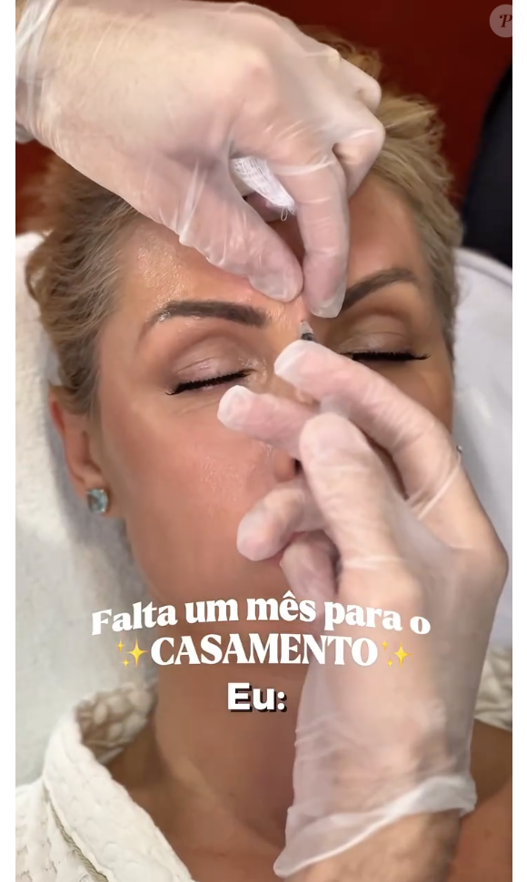 Além do Xerf, Ana Hickmann também fez as tradicionais aplicações de toxina botulínica e bioestimuladores de colágeno