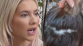 'De novo... Na época da base da Wepink surgiram três': Virginia Fonseca volta a enfrentar diagnóstico de alopecia, faz tratamento e revela alerta de médico