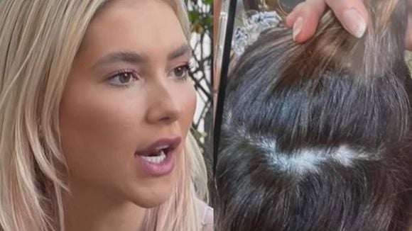 'De novo... Na época da base da Wepink surgiram três': Virginia Fonseca volta a enfrentar diagnóstico de alopecia, faz tratamento e revela alerta de médico