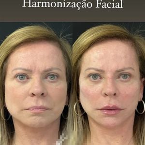 Christina Rocha realizou uma harmonização facial em 2022 que rejuvenesceu muito sua aparência