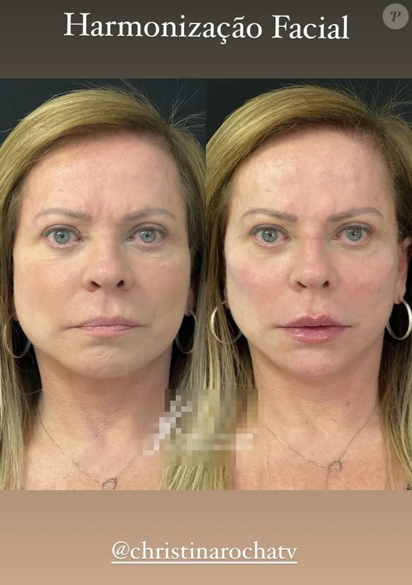 Christina Rocha realizou uma harmonização facial em 2022 que rejuvenesceu muito sua aparência