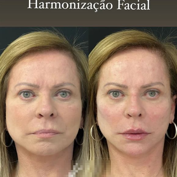 Christina Rocha realizou uma harmonização facial em 2022 que rejuvenesceu muito sua aparência