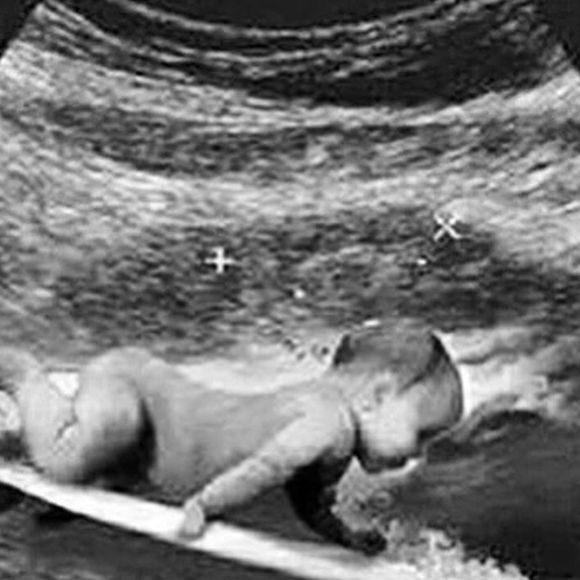Gabriel Medina publicou a foto de uma ultrassonografia diferentona, com um bebê surfista
