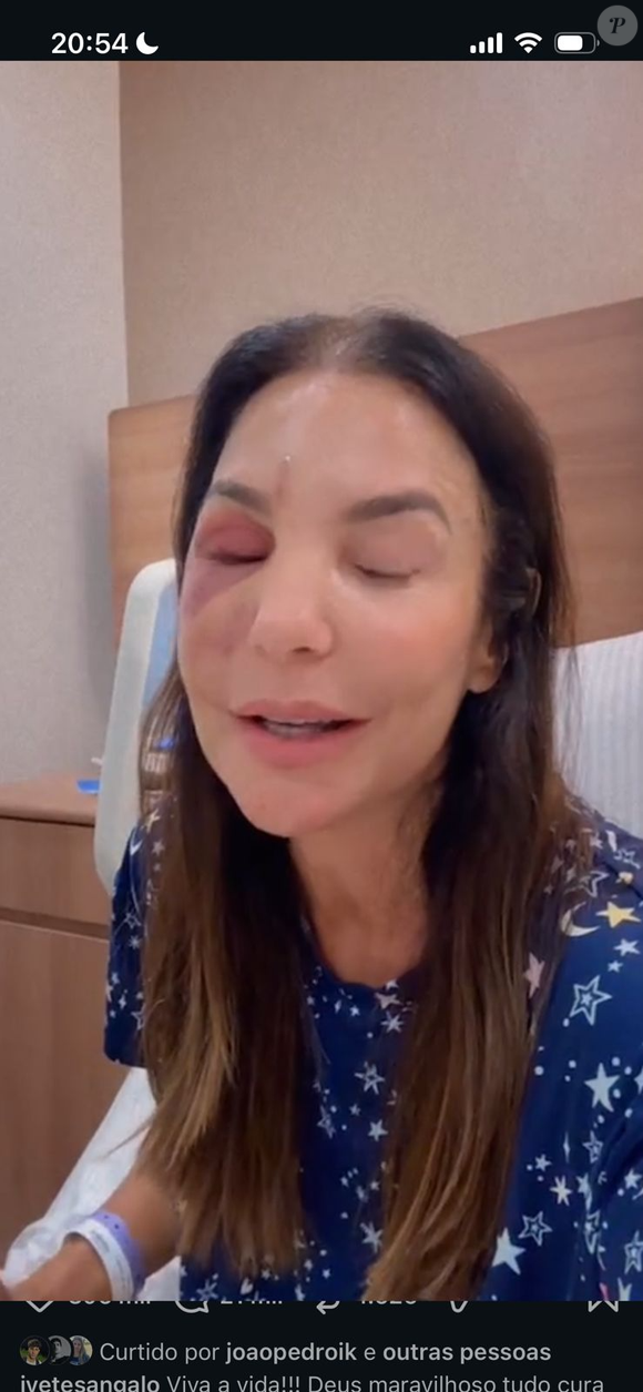 Rosto inchado de Ivete Sangalo após cirurgia para corrigir fratura na região da maçã do rosto