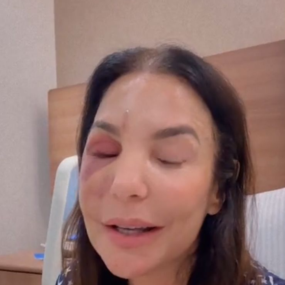 Rosto inchado de Ivete Sangalo após cirurgia para corrigir fratura na região da maçã do rosto