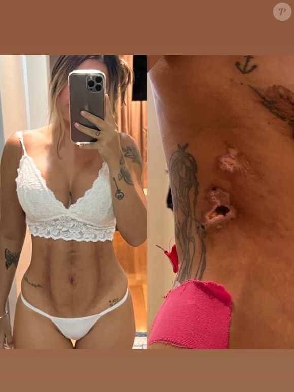 Mariana Tavares afirma que sofreu quadros de necrose na pele e ficou com o corpo deformado após passar por uma série de cirurgias plásticas na clínica JK Estética Avançada