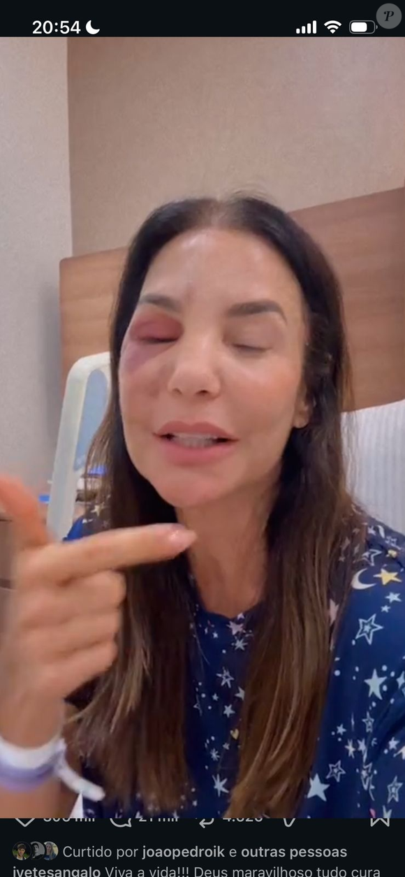 Após desmaiar por causa de síndrome vasovagal, Ivete Sangalo bateu o rosto no chão, fraturou dois ossos e precisou passar por cirurgia