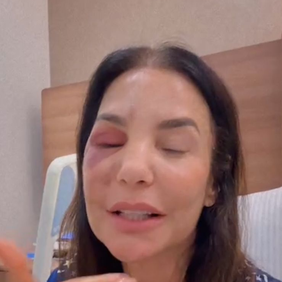 Após desmaiar por causa de síndrome vasovagal, Ivete Sangalo bateu o rosto no chão, fraturou dois ossos e precisou passar por cirurgia