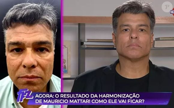 Harmonização facial de Maurício Mattar foi mostrada no 'Fofocalizando', do SBT