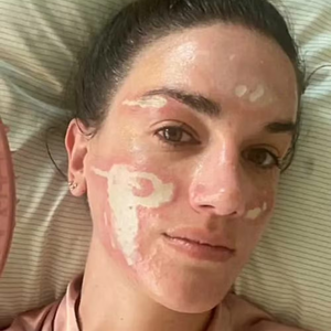 Em um vídeo publicado no Instagram, Victoria Nelson afirmou ter ficado "permanentemente desfigurada" após um tratamento de peeling químico realizado na clínica da esteticista de celebridades Sonya Dakar, em Beverly Hills.