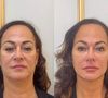 Nadine Gonçalves já havia feito harmonização facial há alguns anos na JK Estética Avançada