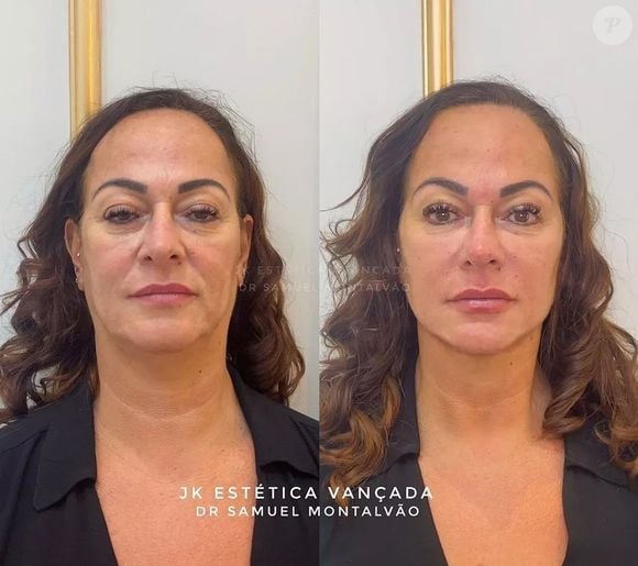 Nadine Gonçalves já havia feito harmonização facial há alguns anos na JK Estética Avançada