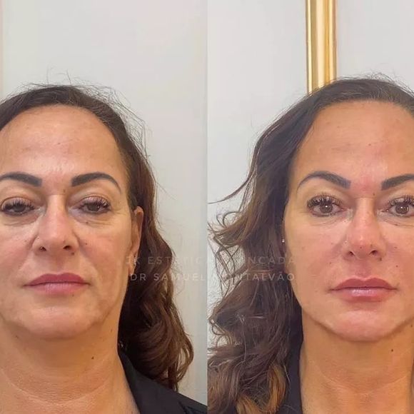 Nadine Gonçalves já havia feito harmonização facial há alguns anos na JK Estética Avançada