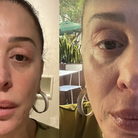 Manual completo: médica tira todas as dúvidas sobre condição que deixou rosto de Claudia Raia inchado. 'Risco de asfixia'