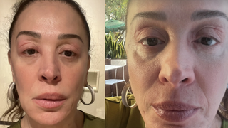 Manual completo: médica tira todas as dúvidas sobre condição que deixou rosto de Claudia Raia inchado. 'Risco de asfixia'