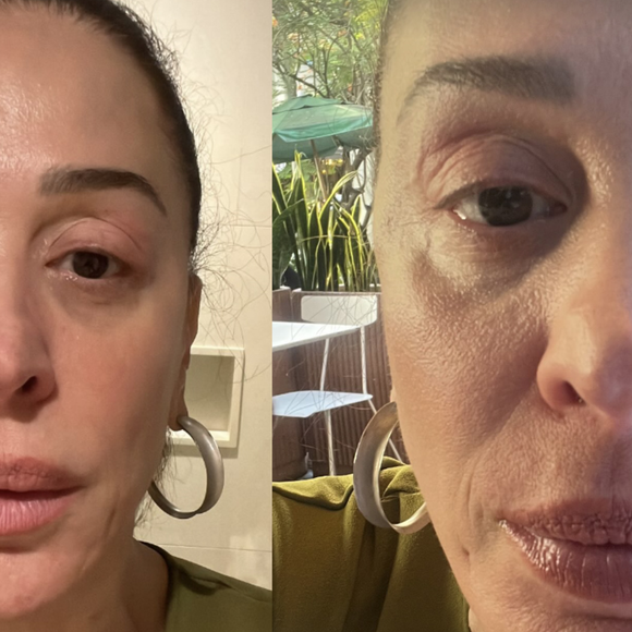 Manual completo: médica tira todas as dúvidas sobre doença que deixou rosto de Claudia Raia inchado. 'Risco de asfixia'