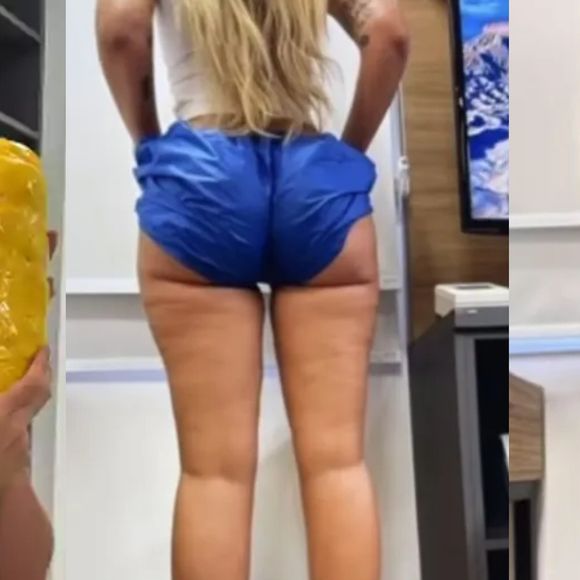 Yasmin Brunet perdeu 14 kg de gordura após tratar o lipedema