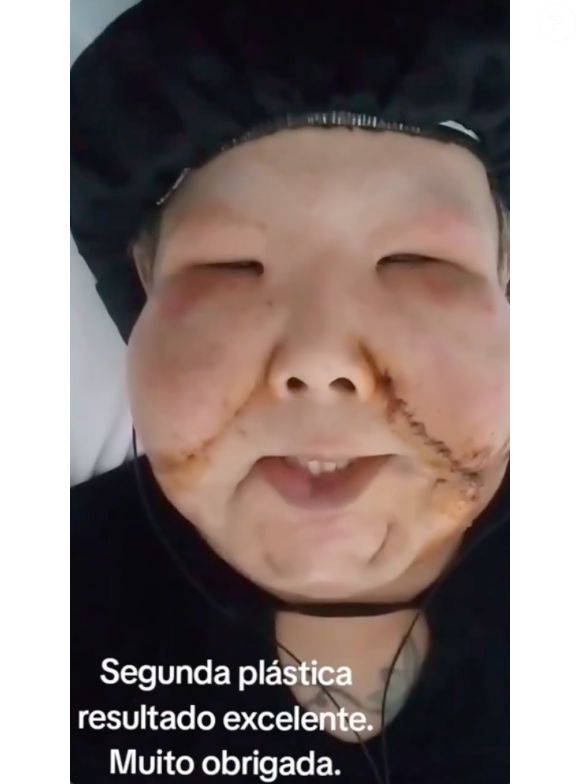 Já em suas redes sociais, Juju do Pix revelou, no último domingo (25), o resultado de sua segunda cirurgia