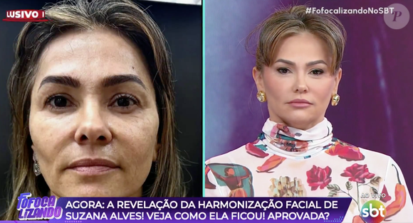 Antes e depois de Suzana Alves: resultado da harmonização facial foi mostrado no 'Fofocalizando'