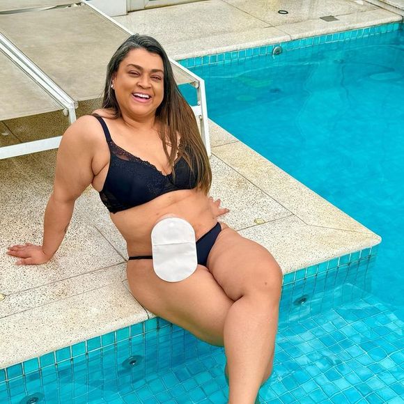 Preta Gil chegou a usar uma bolsa de ileostomia
