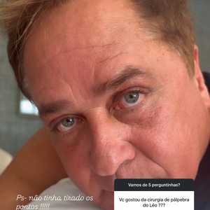 Leonardo passou por uma blefaroplastia no início deste ano