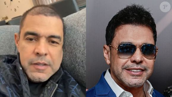 Zezé Di Camargo revelou que a queda de cabelo se deu como efeito colateral da Covid-19, e a tratou com o transplante capilar
