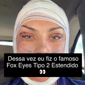 Andressa Urach também destacou os olhos com pontos após a cirurgia e garantiu que o resultado final ainda não está pronto