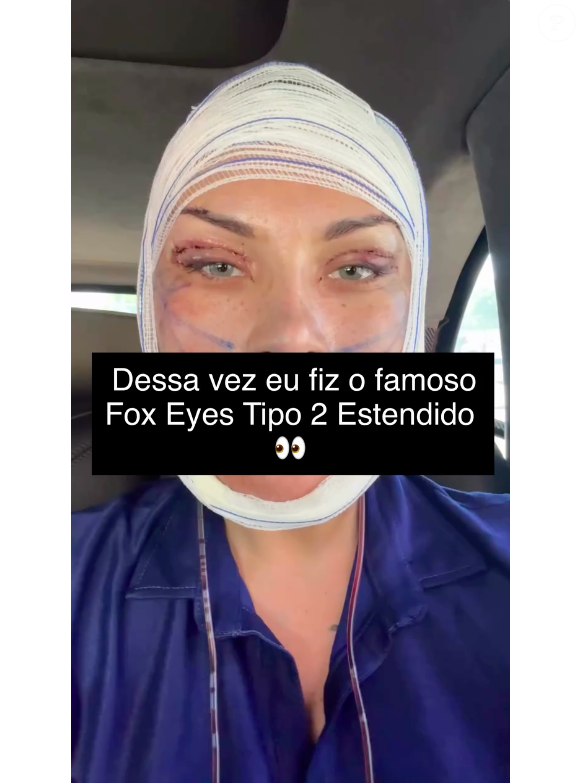 Andressa Urach também destacou os olhos com pontos após a cirurgia e garantiu que o resultado final ainda não está pronto