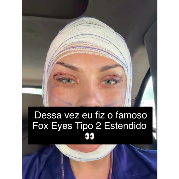 Andressa Urach também destacou os olhos com pontos após a cirurgia e garantiu que o resultado final ainda não está pronto