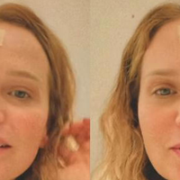 Fernanda Rodrigues retira carcinoma, mostra curativo após cirurgia e deixa alerta: 'Fiquem atentos aos sinais, manchas, pintas...'