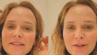 Fernanda Rodrigues retira carcinoma, mostra curativo após cirurgia e deixa alerta: 'Fiquem atentos aos sinais, manchas, pintas...'
