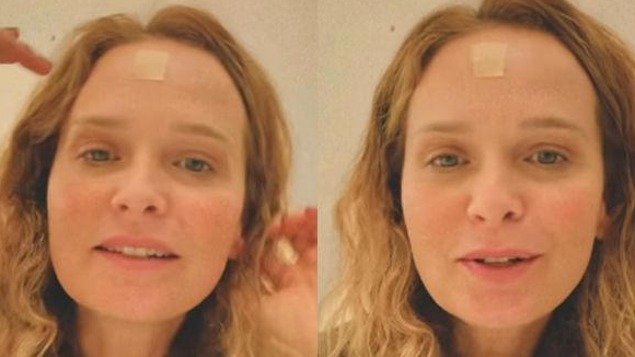 Fernanda Rodrigues retira carcinoma, mostra curativo após cirurgia e deixa alerta: 'Fiquem atentos aos sinais, manchas, pintas...'