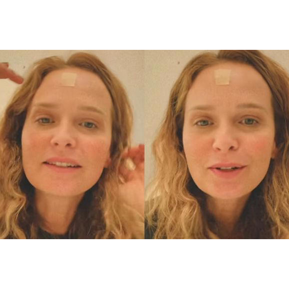 Fernanda Rodrigues retira carcinoma, mostra curativo e deixa alerta aos fãs: 'Fiquem atentos aos sinais, manchas, pintas...'