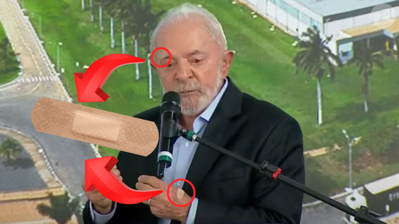 Coincidência: Lula também retirou um nevo melanocítico em abril e apareceu com curativo no rosto