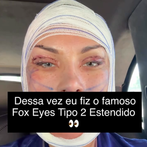 Andressa Urach voltou a aparecer nas redes sociais após uma nova cirurgia de R$ 100 mil no rosto