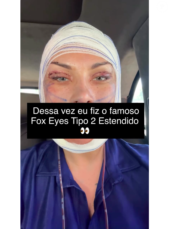 Andressa Urach voltou a aparecer nas redes sociais após uma nova cirurgia de R$ 100 mil no rosto