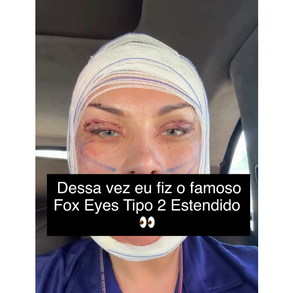 Andressa Urach voltou a aparecer nas redes sociais após uma nova cirurgia de R$ 100 mil no rosto