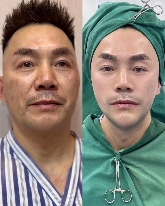 Além de mulheres, Dr. Lifeng também realiza facelift em homens