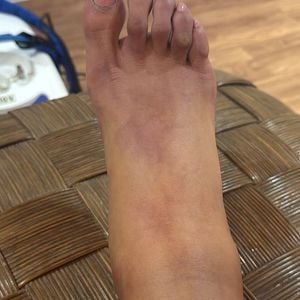 O aumento repentino no peso foi resultado da retenção de líquidos durante o período em que esteve internada para realizar uma cirurgia no joelho, após sofrer uma lesão durante sua participação no Dança dos Famosos.