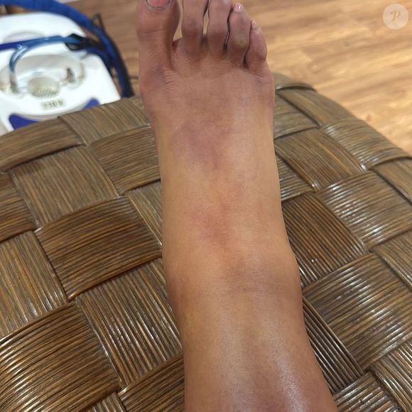 O aumento repentino no peso foi resultado da retenção de líquidos durante o período em que esteve internada para realizar uma cirurgia no joelho, após sofrer uma lesão durante sua participação no Dança dos Famosos.