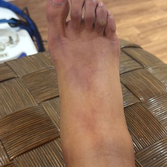 O aumento repentino no peso foi resultado da retenção de líquidos durante o período em que esteve internada para realizar uma cirurgia no joelho, após sofrer uma lesão durante sua participação no Dança dos Famosos.