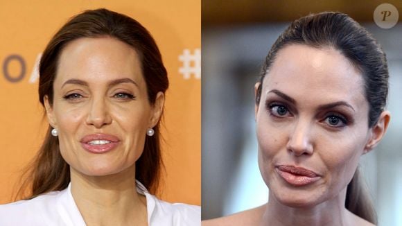 Angelina Jolie aplica a toxina botulínica nas maçãs do rosto, testa e região dos olhos
