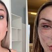 Antes e depois de Andressa Urach: 'toda esticada' em novo vídeo, influenciadora divide opiniões com 'resultado' de plástica de R$ 100 mil. 'Assusta de um jeito bom'
