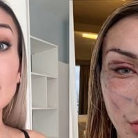 Antes e depois de Andressa Urach: 'toda esticada' em novo vídeo, influenciadora divide opiniões com 'resultado' de plástica de R$ 100 mil. 'Assusta de um jeito bom'