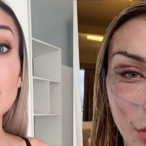 Antes e depois de Andressa Urach: influenciadora divide opiniões com 'resultado' de plástica de R$ 100 mil. 'Assusta de um jeito bom'