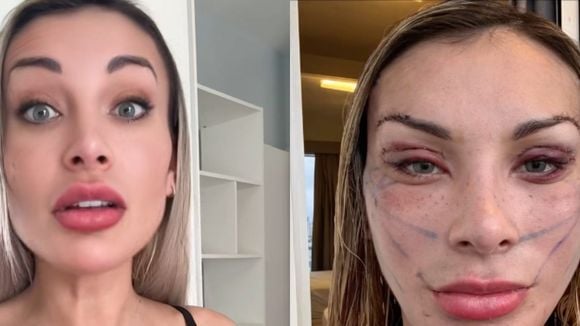 Antes e depois de Andressa Urach: 'toda esticada' em novo vídeo, influenciadora divide opiniões com 'resultado' de plástica de R$ 100 mil. 'Assusta de um jeito bom'