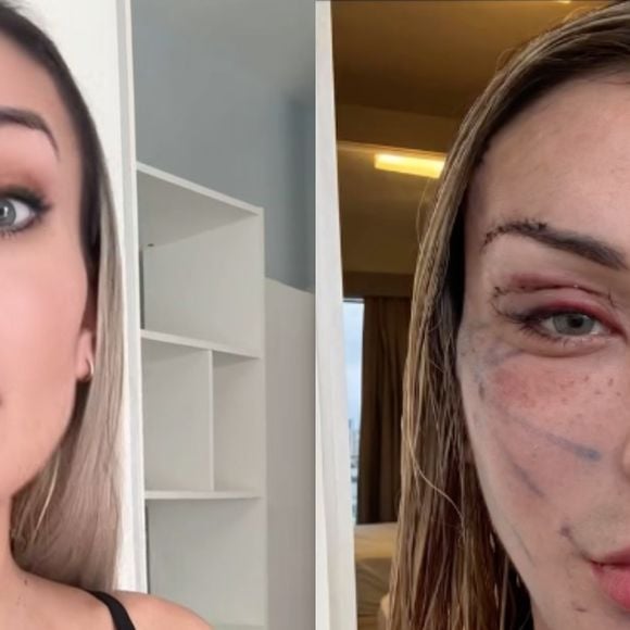 Antes e depois de Andressa Urach: influenciadora divide opiniões com 'resultado' de plástica de R$ 100 mil. 'Assusta de um jeito bom'